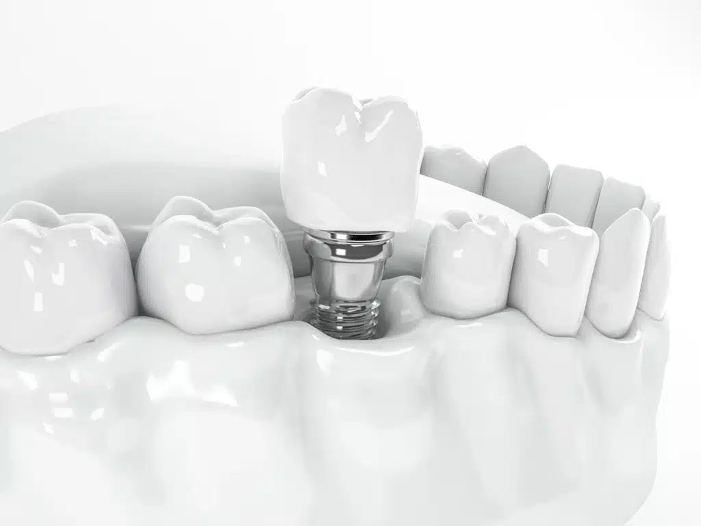 Restoring Your Smile with Dental Implants in Hamilton