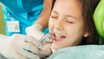 Teeth-Extractions
