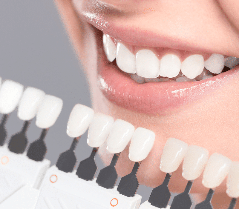 Teeth-whitening