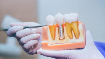 Experience-the-Difference-Dental-Implants-in-Hamilton