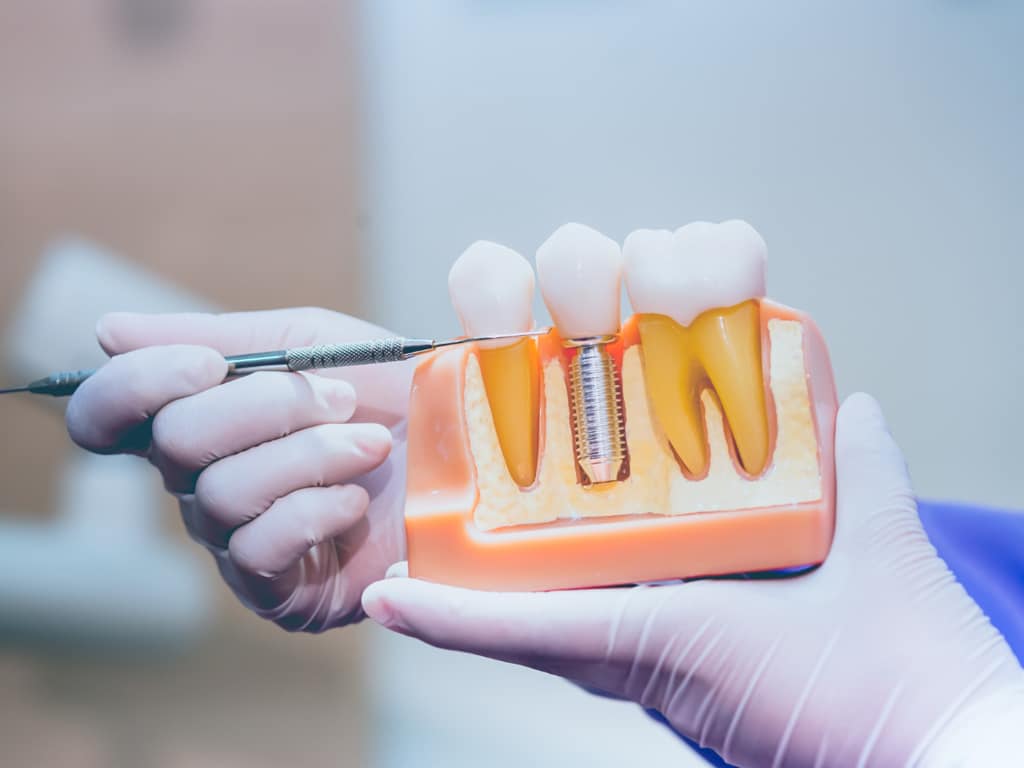 Experience-the-Difference-Dental-Implants-in-Hamilton