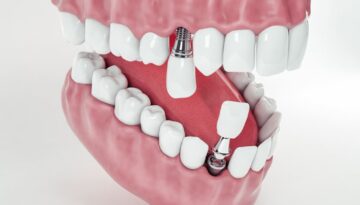 Get-a-Permanent-Smile-with-Dental-Implants-in-Hamilton