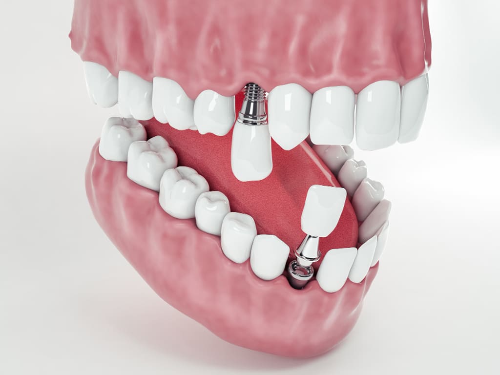 Get-a-Permanent-Smile-with-Dental-Implants-in-Hamilton