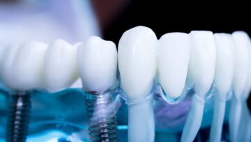 The-Dental-Implant-Process-in-Hamilton-From-Consultation-to-Confident-Smile