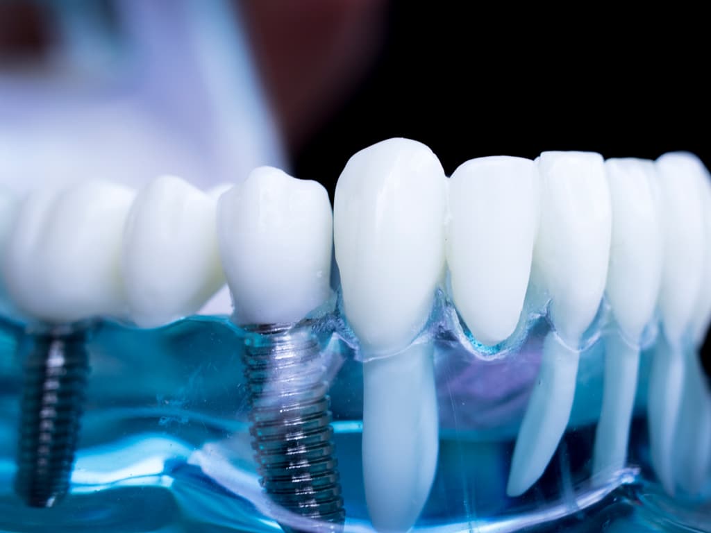 The-Dental-Implant-Process-in-Hamilton-From-Consultation-to-Confident-Smile