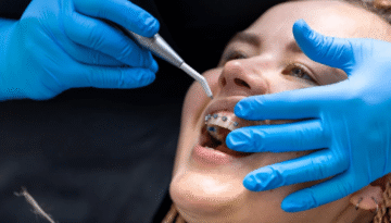 Dental Hygiene for Braces The Complete Guide to Brushing and Flossing with Orthodontics