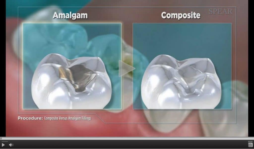 amalgam restoration procedure