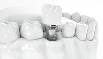 Restoring-Your-Smile-with-Dental-Implants-in-Hamilton-Nebo