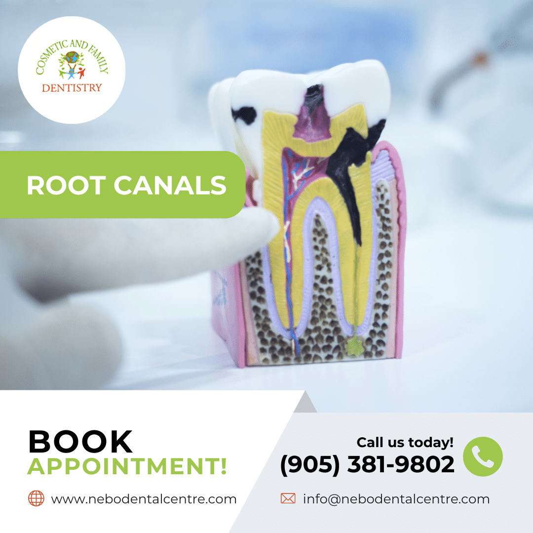 Root Canals