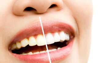 Invisalign-and-Teeth-Whitening-Achieving-a-Straighter,-Brighter-Smile-in-Hamilton
