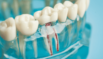 N-Is it a Cavity or a Root Canal 5 Warning Signs You Shouldn't Ignore