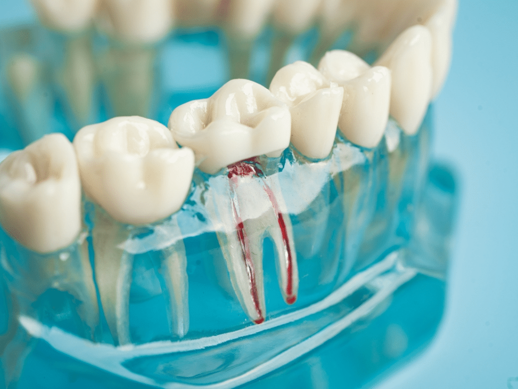 N-Is it a Cavity or a Root Canal 5 Warning Signs You Shouldn't Ignore N-Is it a Cavity or a Root Canal 5 Warning Signs You Shouldn't Ignore