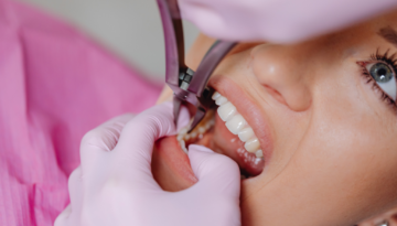 Emergency Dental Fillings in Hamilton Saving a Broken or Chipped Tooth Fast