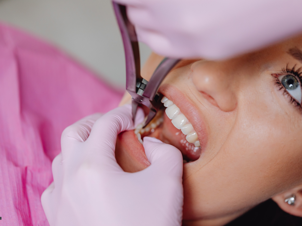 Emergency Dental Fillings in Hamilton Saving a Broken or Chipped Tooth Fast