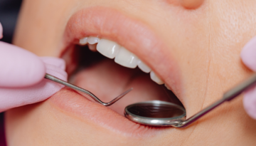 Root Canal Recovery What to Expect and How to Manage Post-Treatment Discomfort